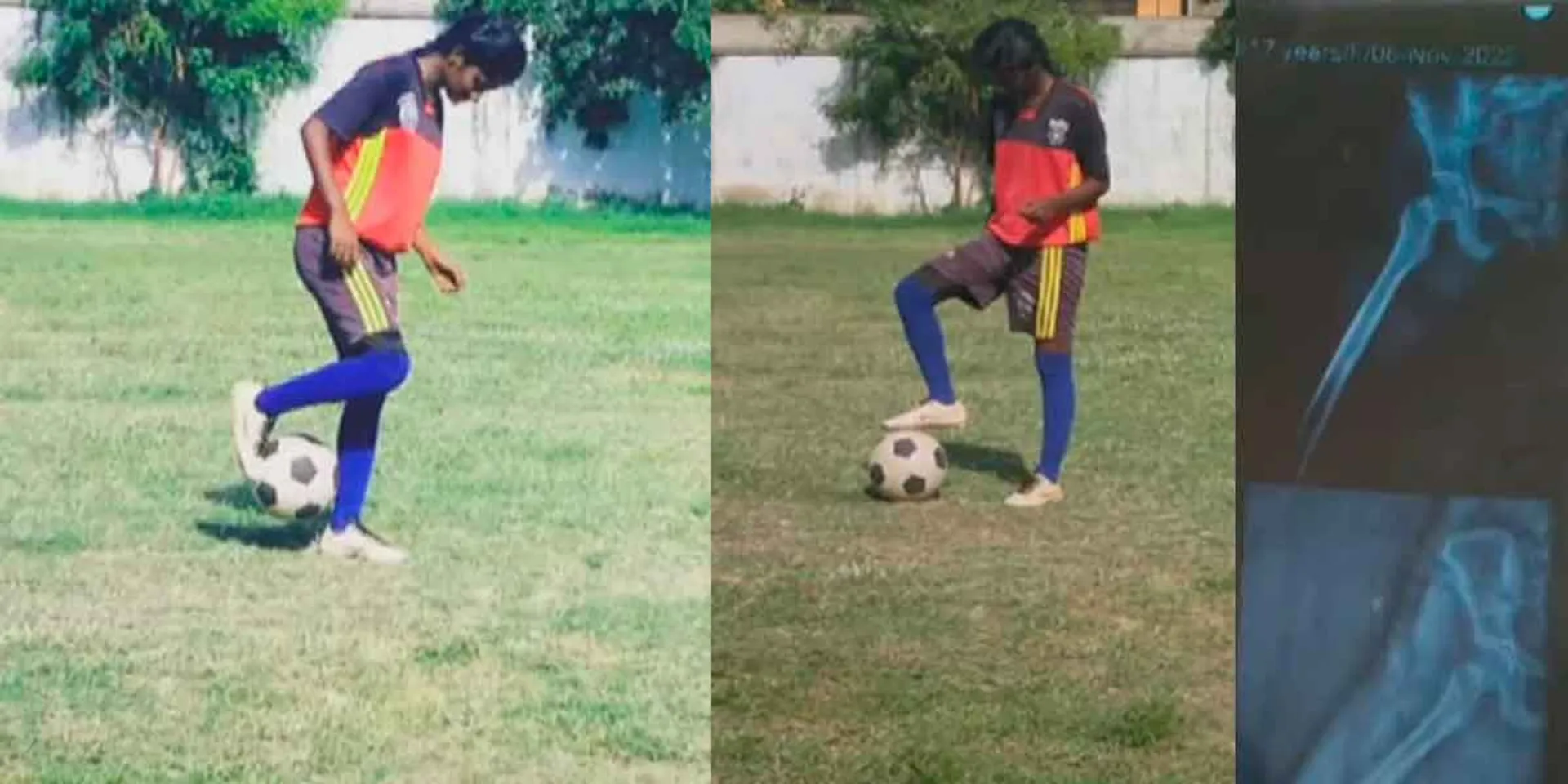  Football player after having her leg amputated