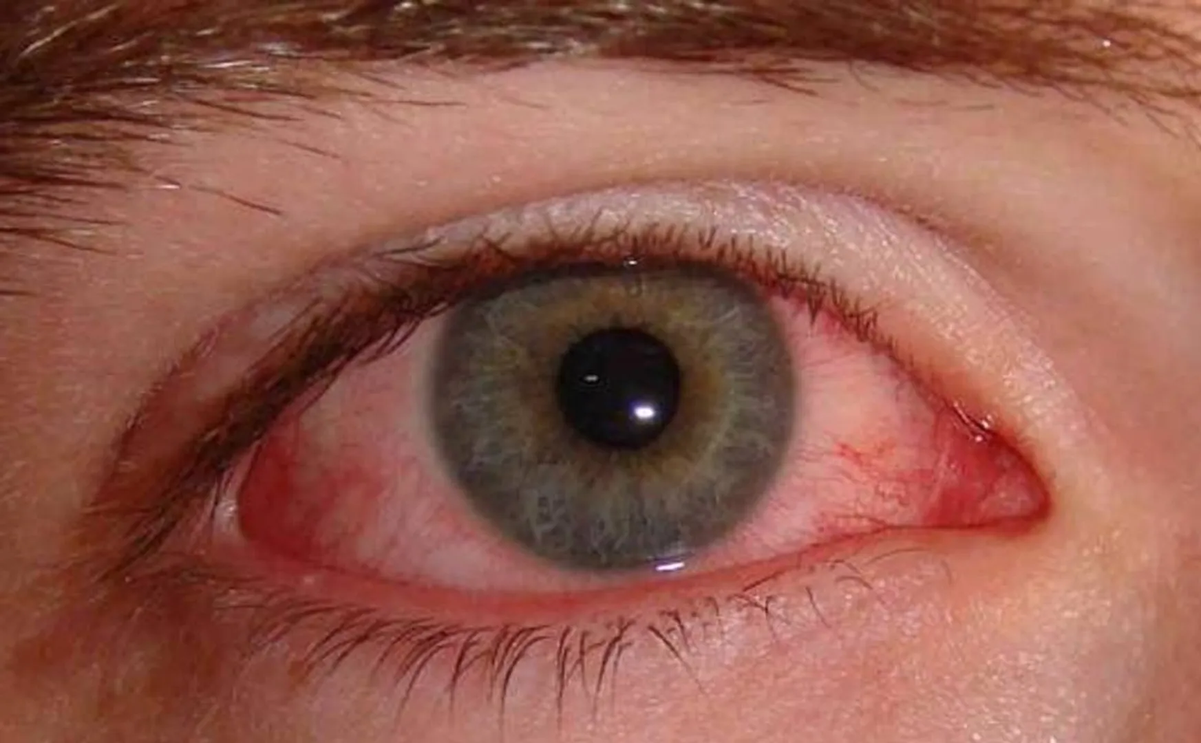 Madras eye infection spread 