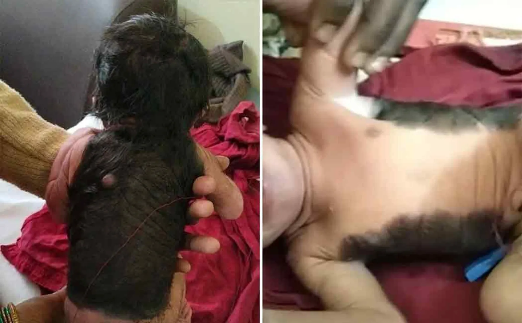 A baby born with hair all over his back