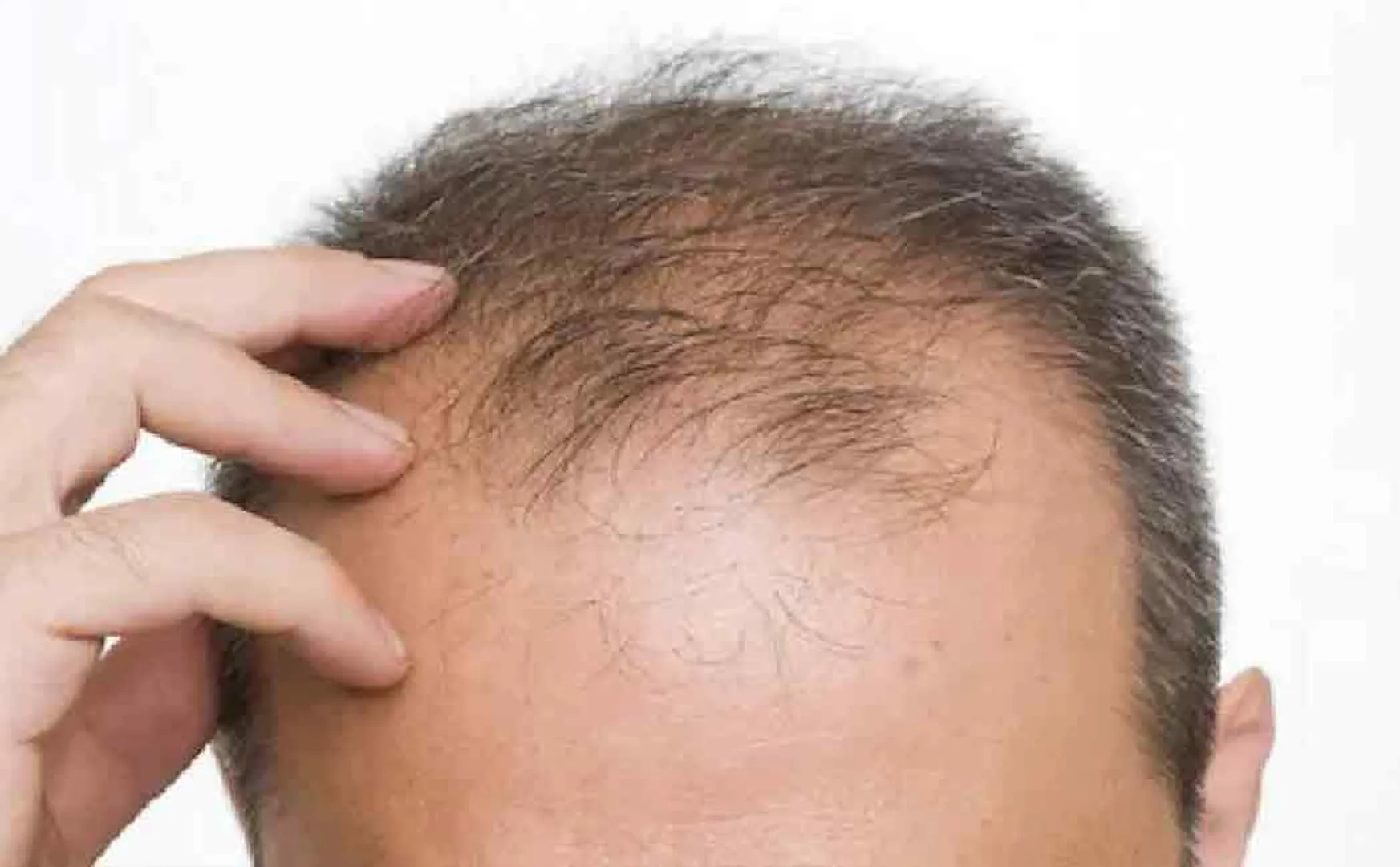 Rs.6000 monthly pension for bald heads!!