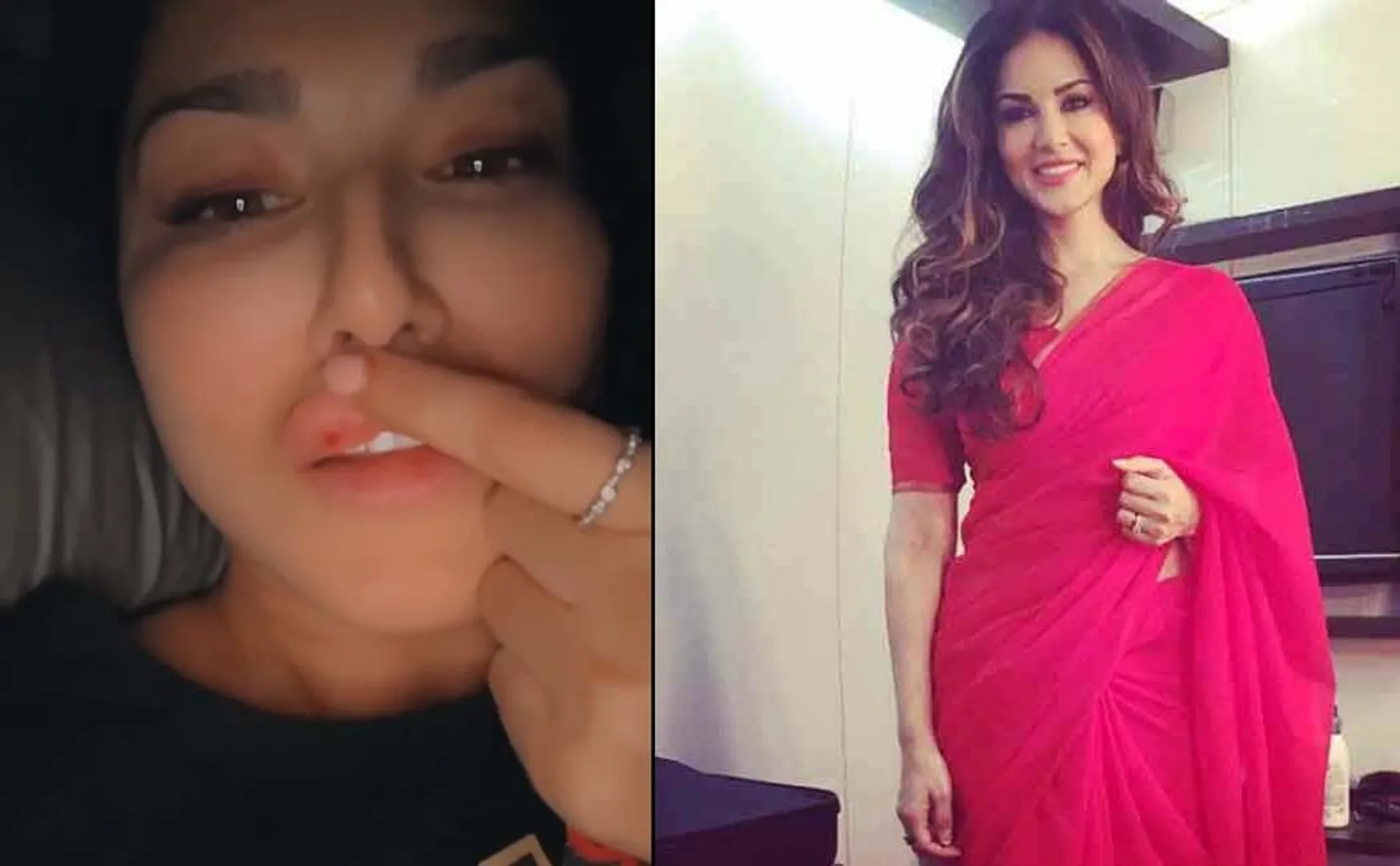 lip injury caused by selfie; Sunny Leone is tormented