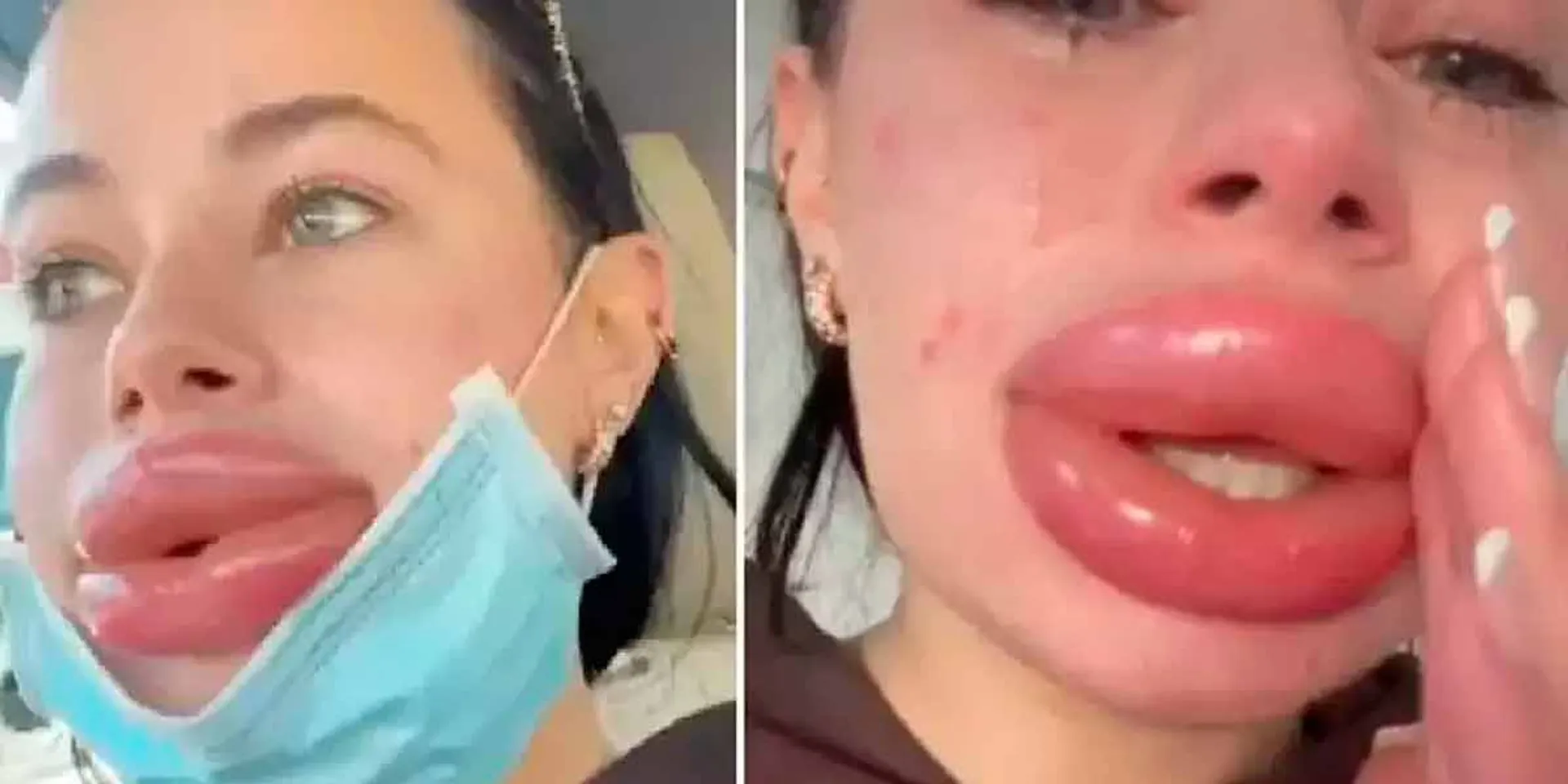 Lip fillers suffer from lip fillers; an overdose does not happen to the lips either