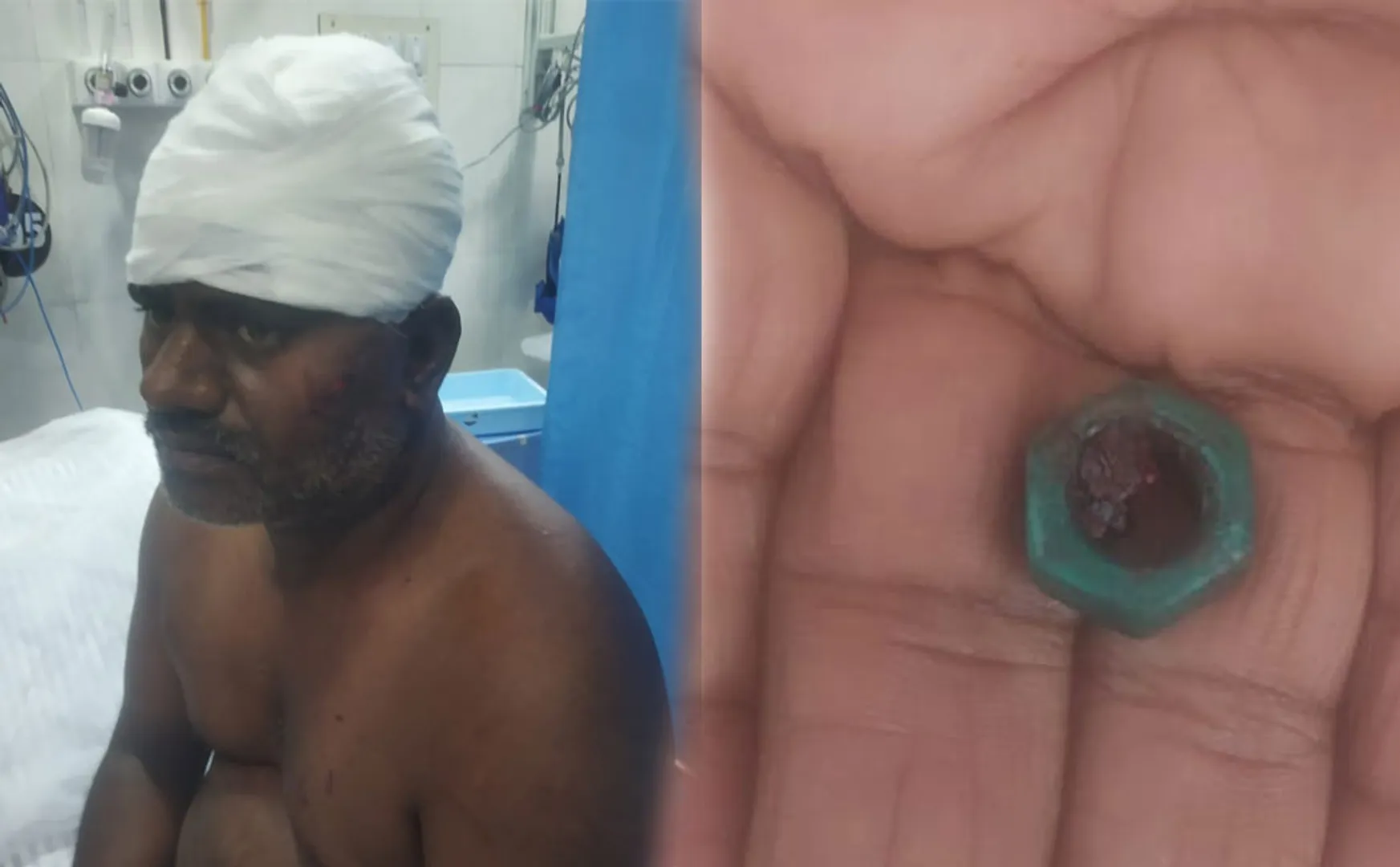 Doctors put bolt head  person who came treatment government hospital and stitch it
