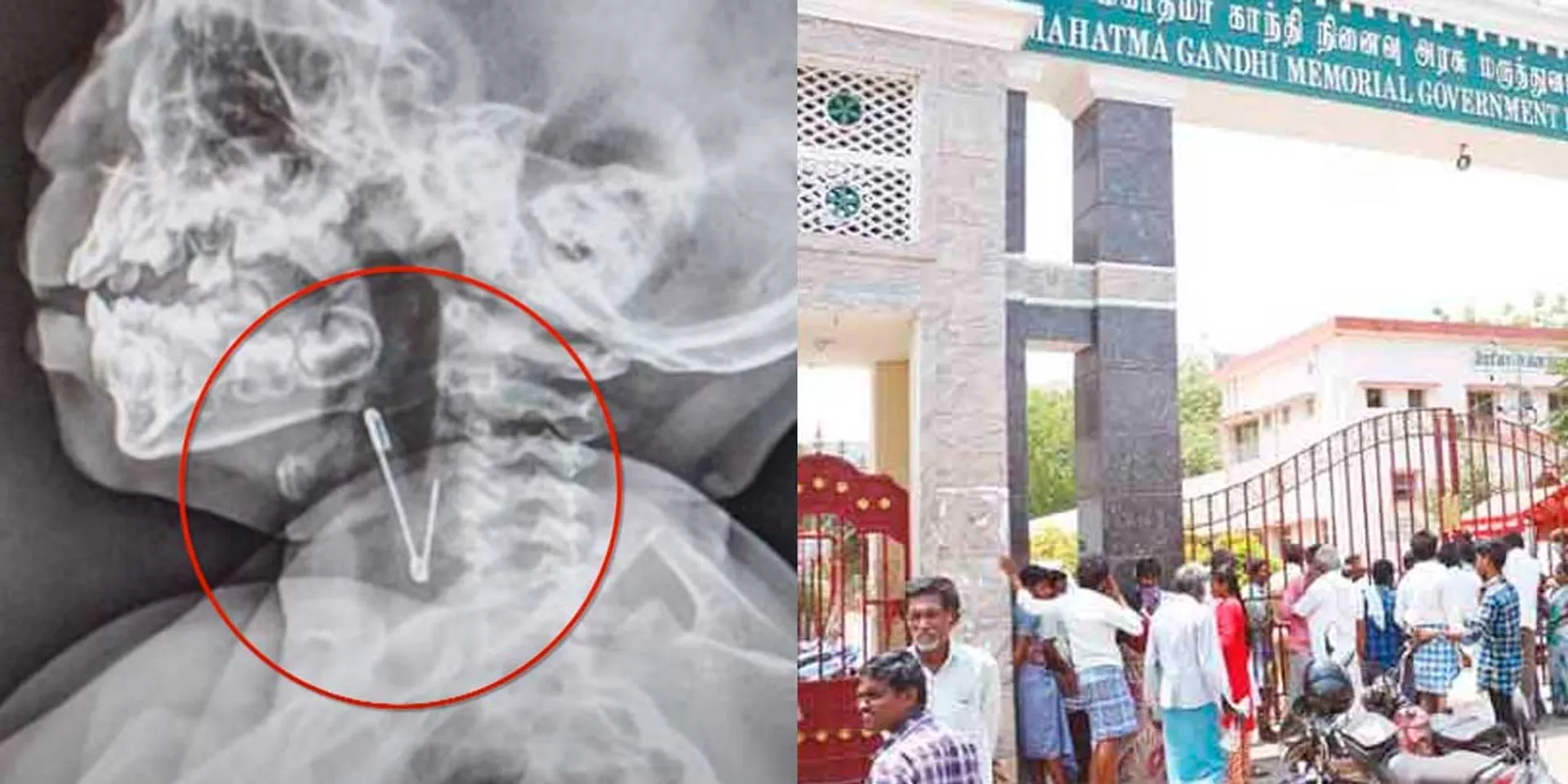 Trichy boy problem; Cleverly corrected doctors