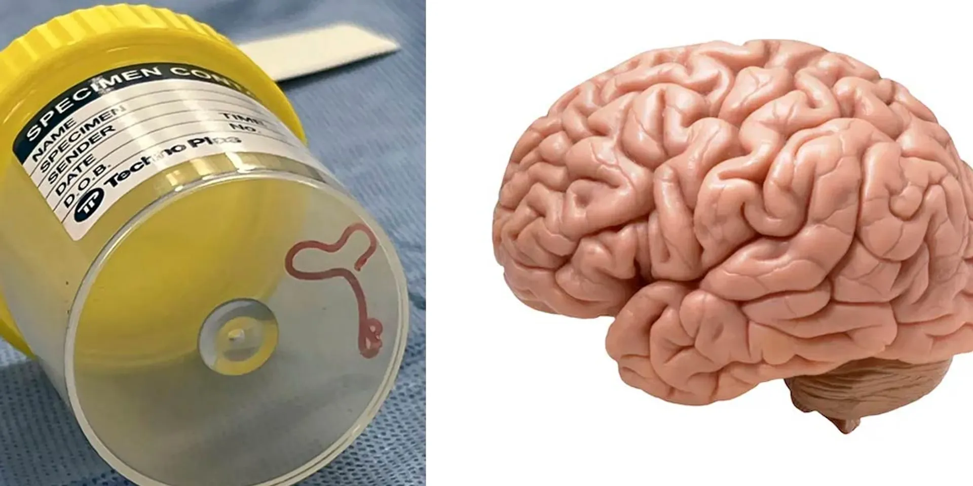  An 8 cm worm coiled in the brain
