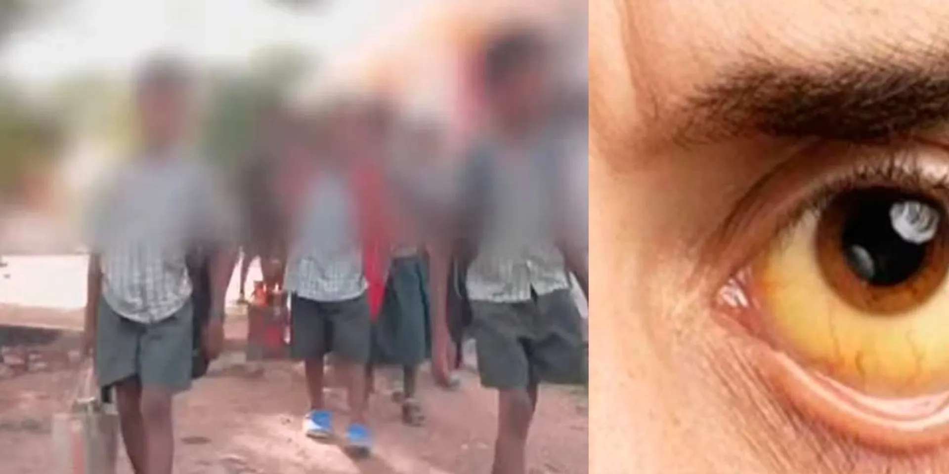  12 students with jaundice; Wayalogam village in fear