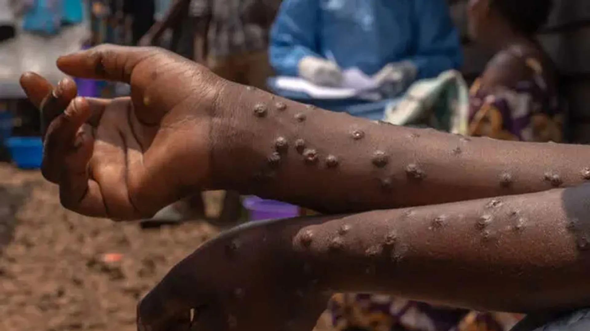 Monkey pox in one person in Kerala