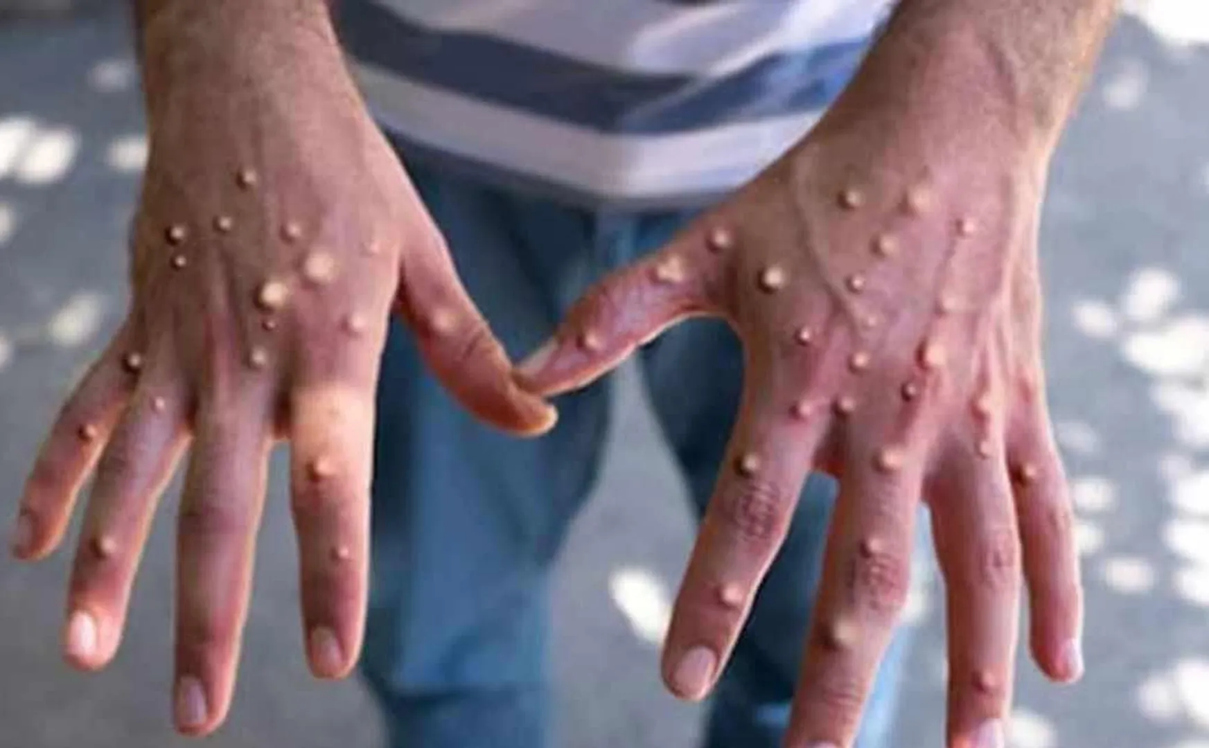 A person who came from Tamil Nadu was affected by monkeypox