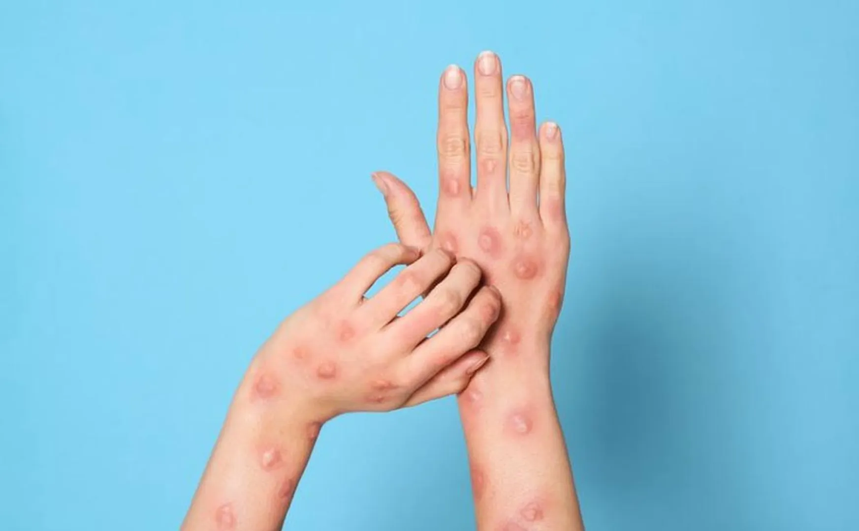 Trichy Collector's information on The youth admitted to the hospital does not have MPOX