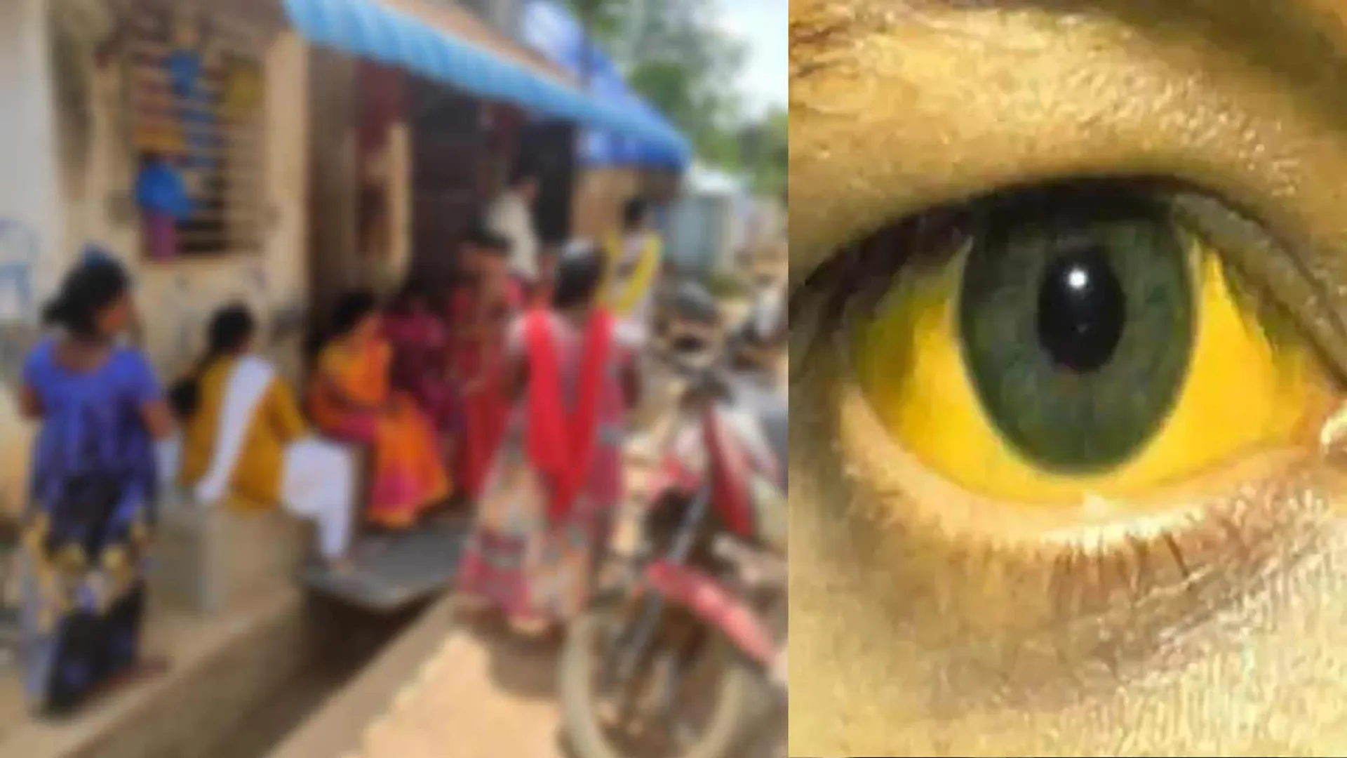 Over 30 children in jaundice-shocked villagers