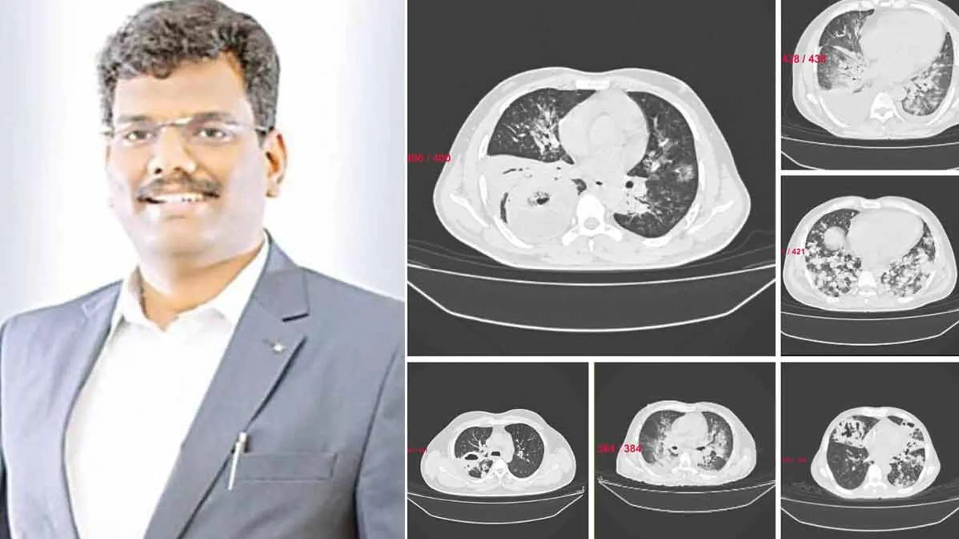  'New Lung Diseases Caused by Climate Change' - Doctor's Advice to Stay Safe