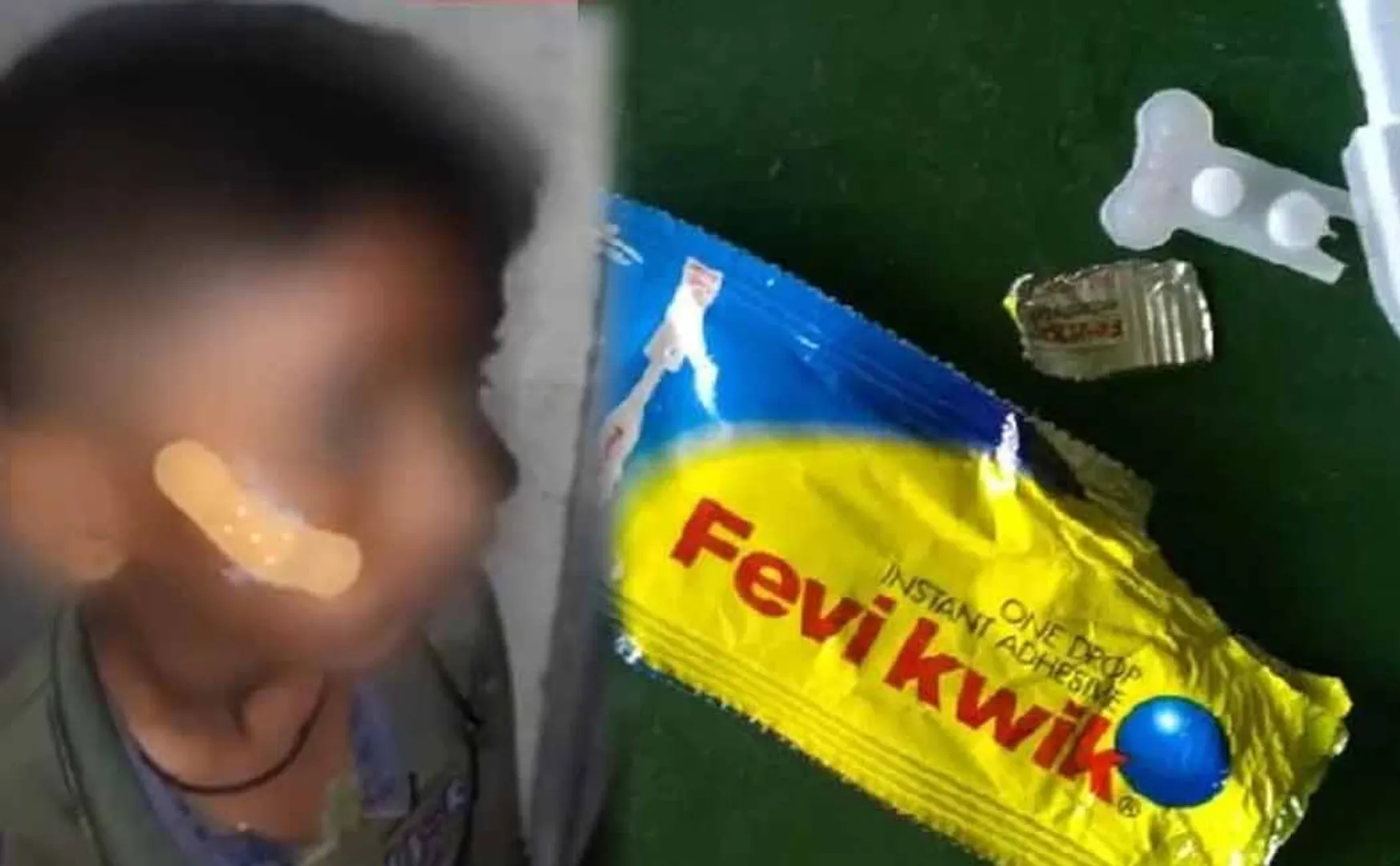 Nurse applies Fevikwik to boy with cheek injury instead of stitching  