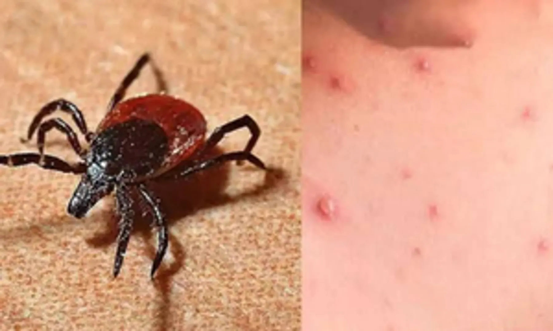 scrub typhus story pic