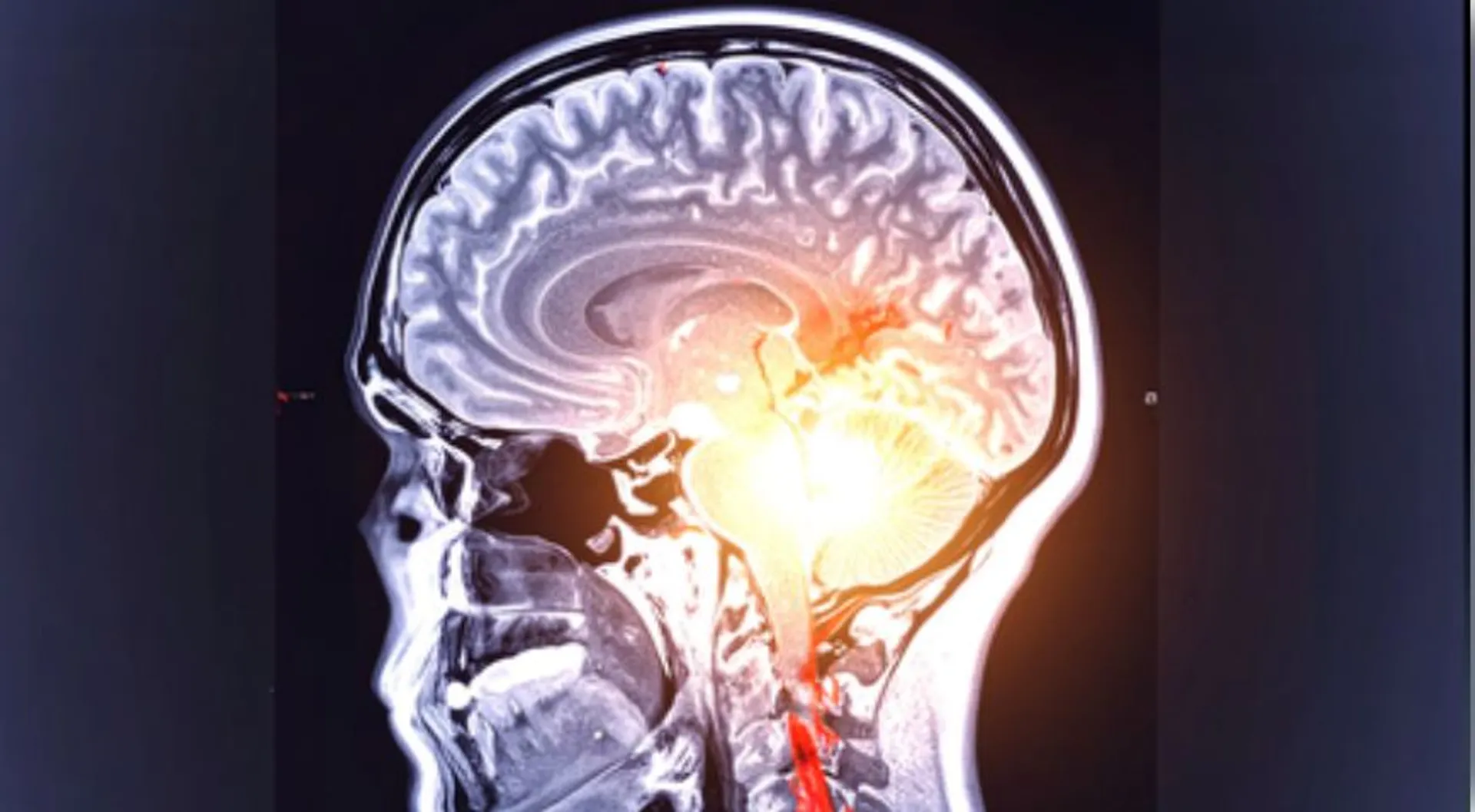 brain x ray