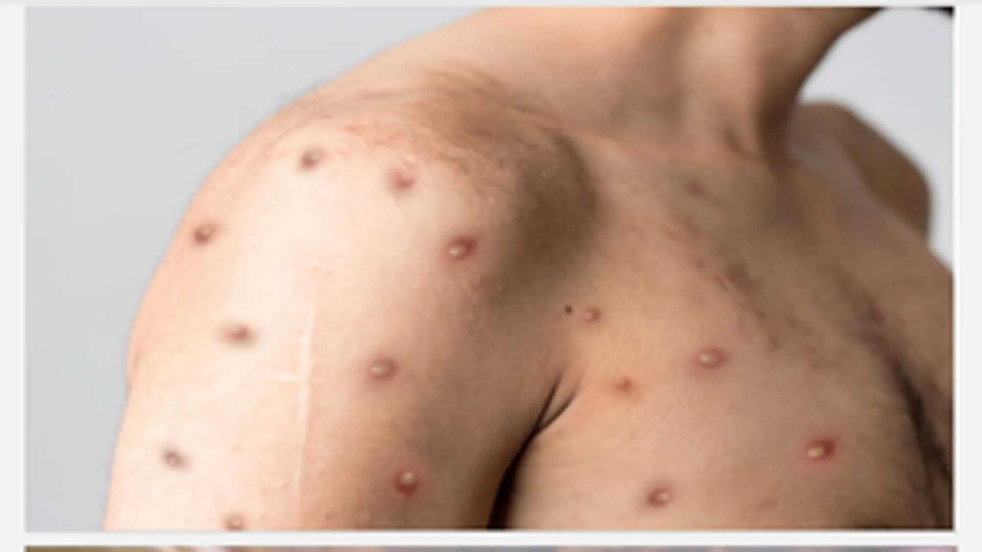 Mpox case