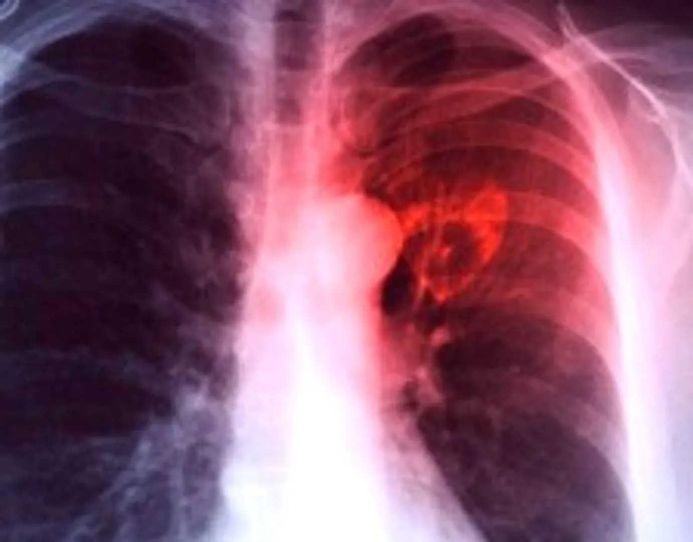 17 die of TB in tribal village of Odisha’s Keonjhar district