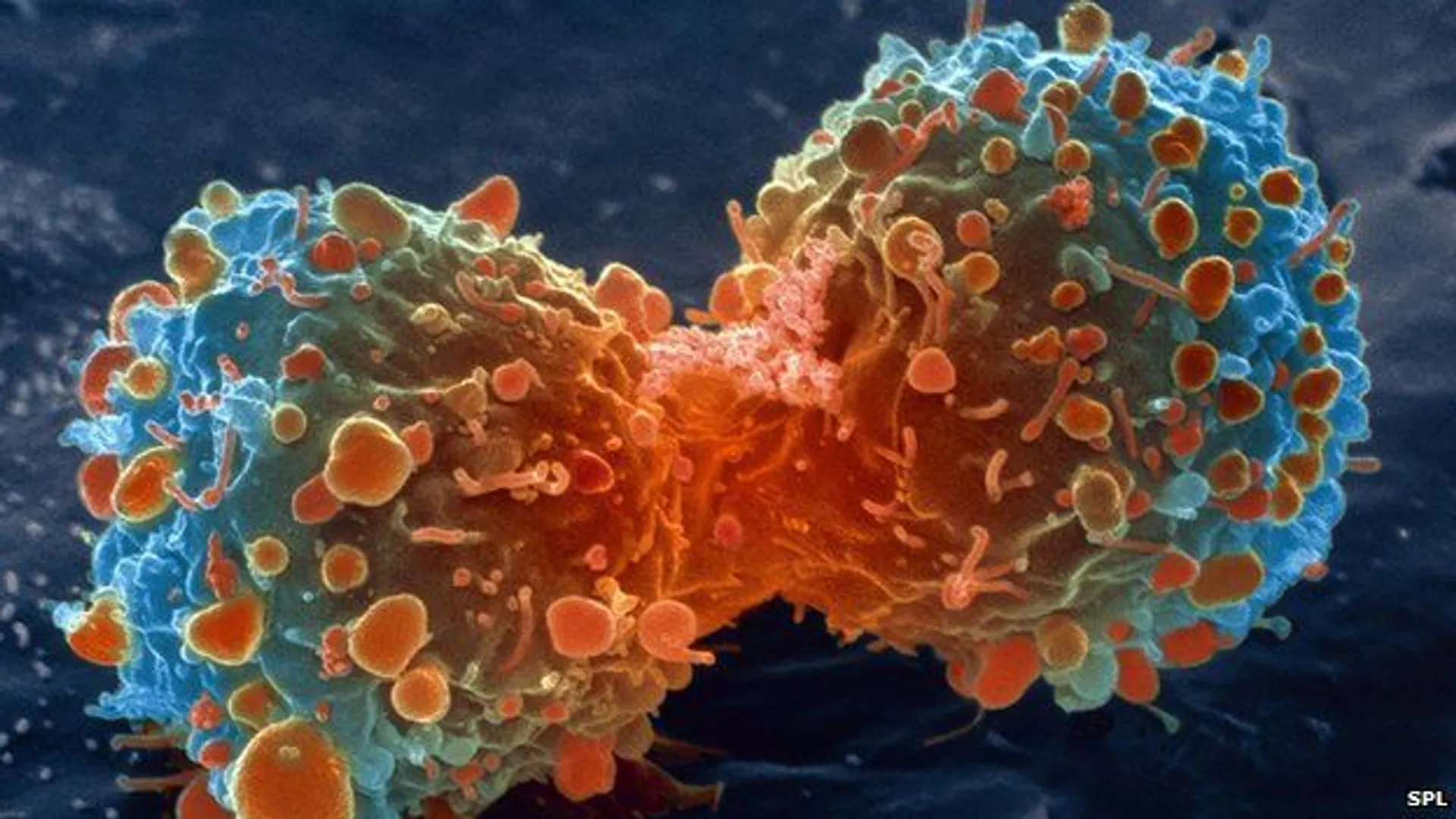 How lung cancer spread can be prevented