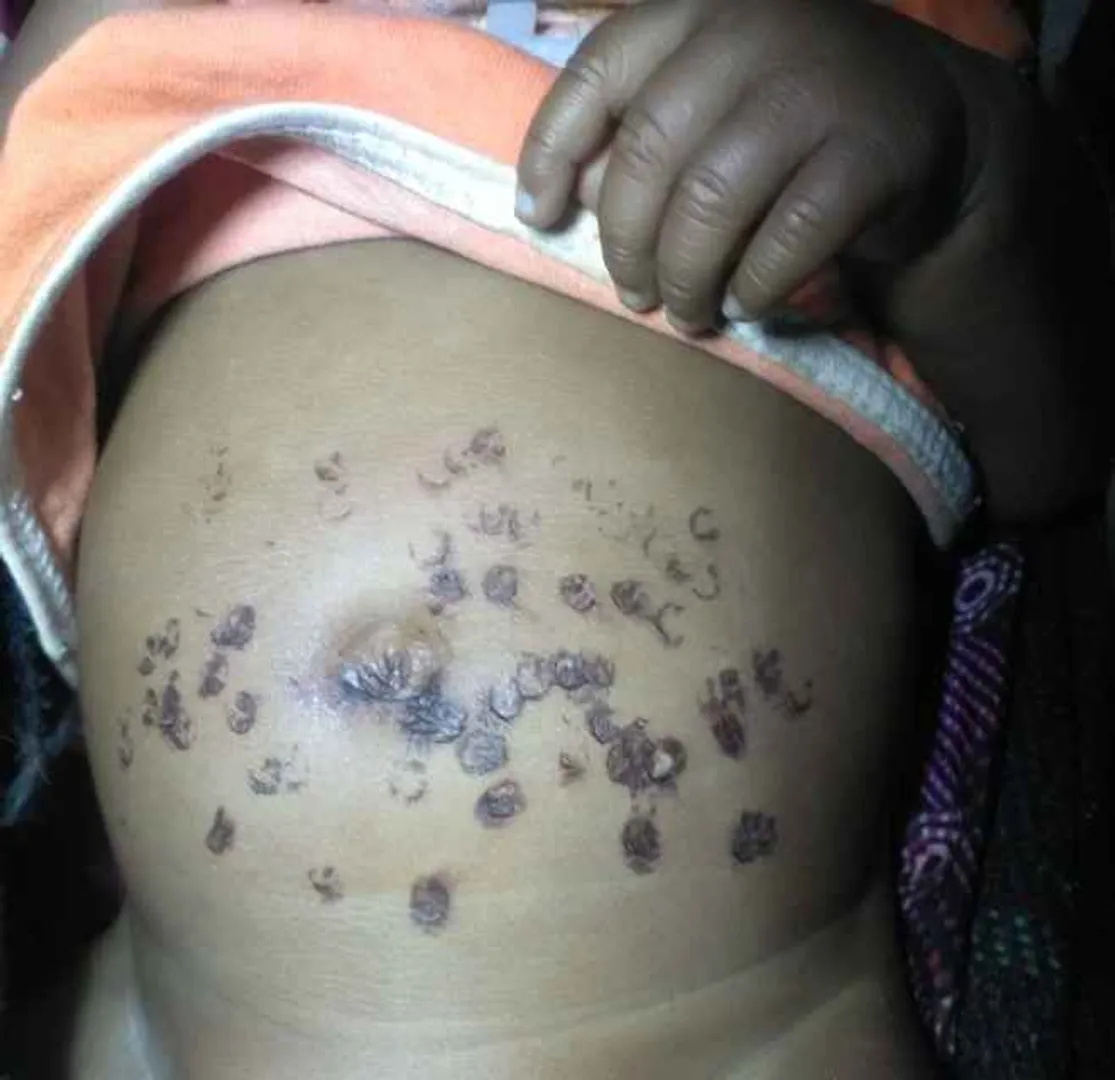 Child branded with hot iron dies at MKCG Hospital in Odisha