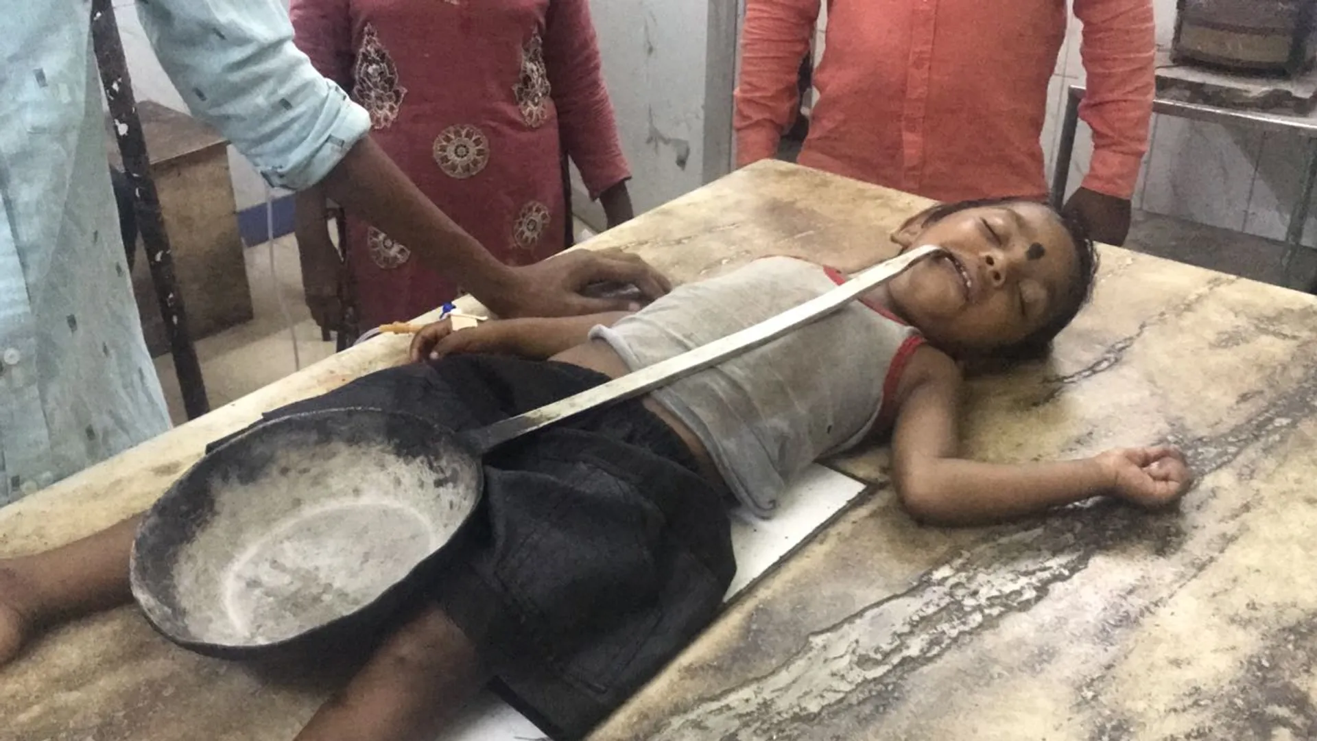 ଝାରସୁଗୁଡ଼ା: ଖେଳୁଥିବା ବେଳେ ୩ ବର୍ଷର ଶିଶୁ ପାଟିରେ ଫସିଲା ଫ୍ରାଏପେନ୍‌ ହ୍ୟାଣ୍ଡେଲ