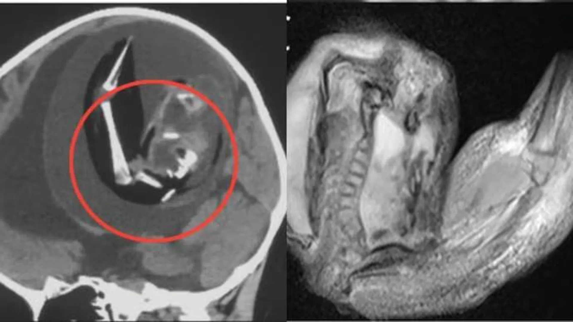 ବର୍ଷକର ଶିଶୁ ମସ୍ତିଷ୍କରୁ ଯାଆଁଳା ଭ୍ରୂଣ ବାହାର କଲେ ଡାକ୍ତର