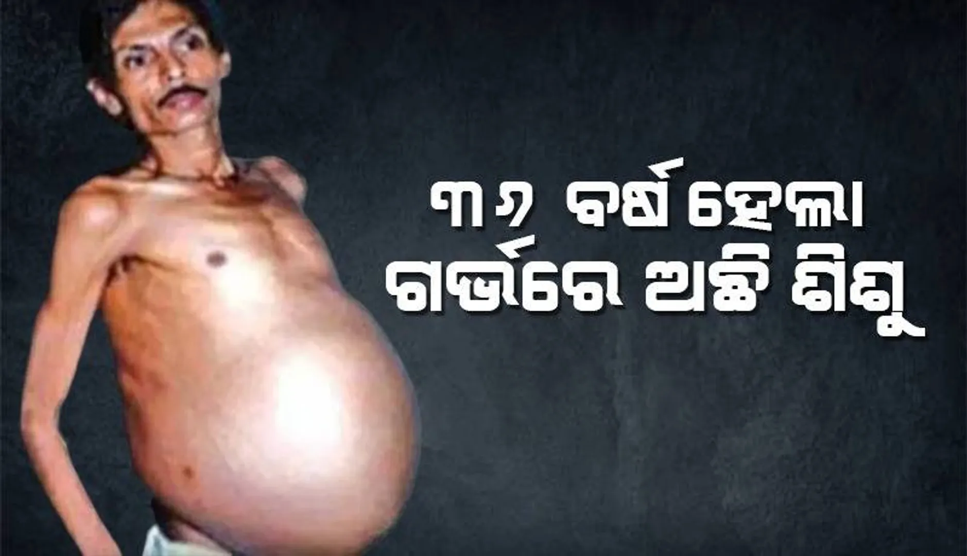 ମାଆ ଗର୍ଭରେ ଥିବା ବେଳରୁ ଅନ୍ୟ ଯାଆଁଳା ପିଲାକୁ ନିଜ ପେଟରେ ଧରି ବୁଲୁଛନ୍ତି ସଞ୍ଜୁ... ୫୦୦,୦୦୦ଙ୍କ ମଧ୍ୟରେ ଜଣଙ୍କଠାରେ ଏହା ଘଟିଥାଏ