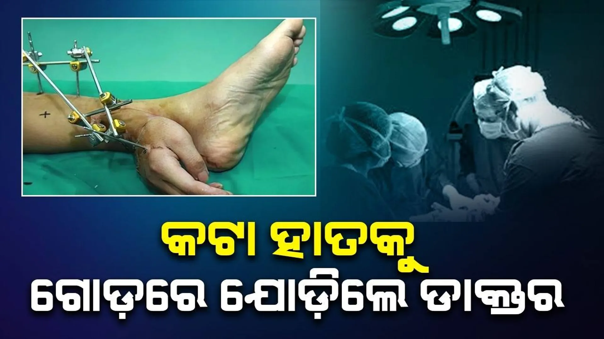 ଶ୍ରମିକଙ୍କ କଟା ହାତକୁ ବଞ୍ଚାଇ ରଖିବା ପାଇଁ ଡାକ୍ତର ଗୋଡରେ ଅସ୍ତ୍ରୋପଚାର କରି ଯୋଡ଼ି ଦେଲେ