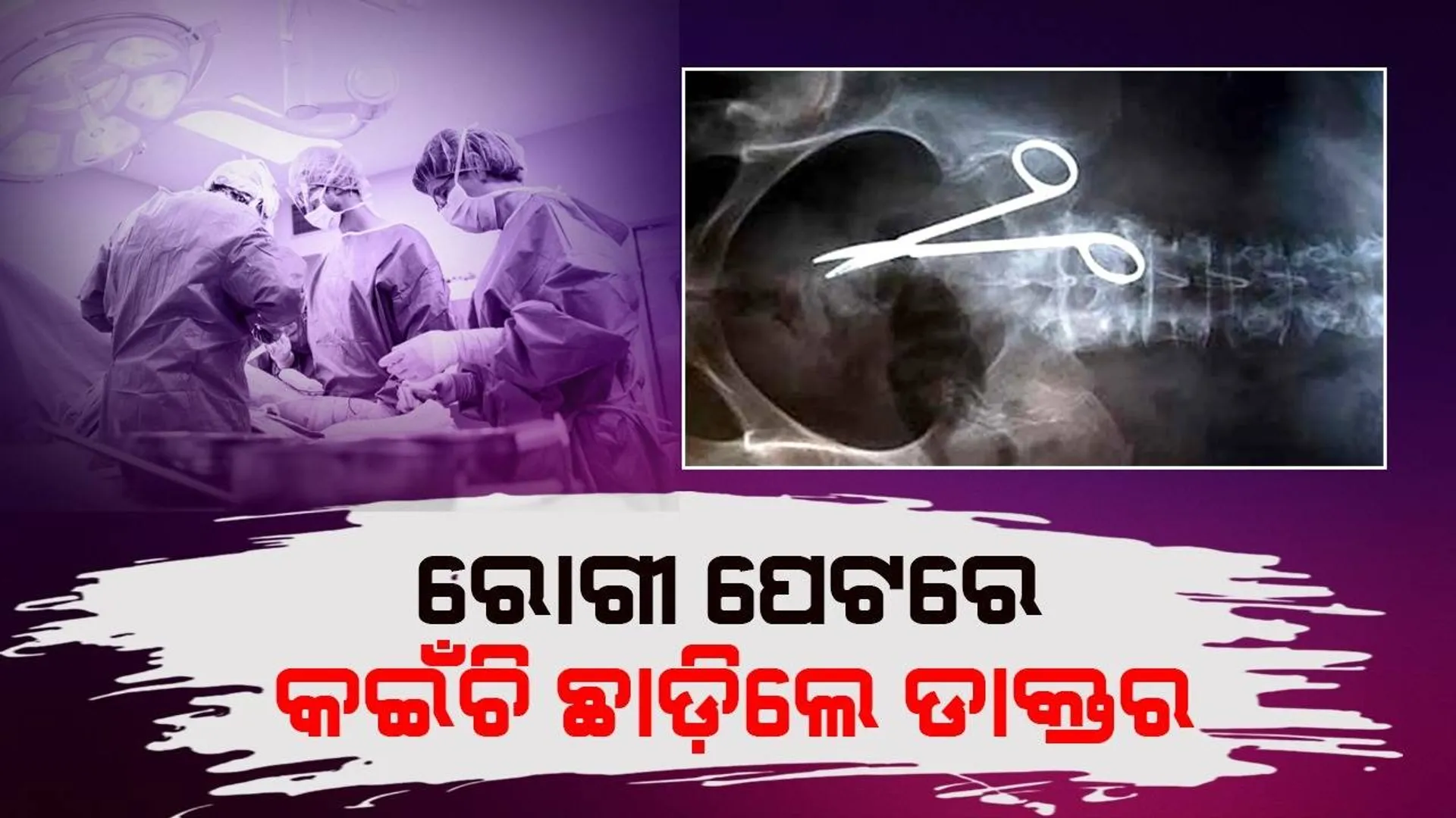 ଅସ୍ତ୍ରୋପଚାର ସମୟରେ ପେଟରେ ଡାକ୍ତର ଛାଡ଼ି ଦେଇଥିଲେ କଇଁଚି; ୧ବର୍ଷ ପରେ ବୃଦ୍ଧାଙ୍କ ହେଲା ଏଭଳି ଅବସ୍ଥା