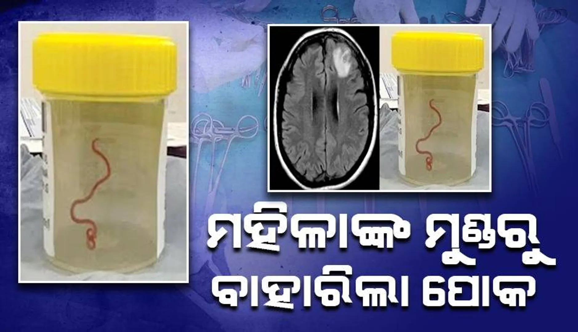 ବୃଦ୍ଧାଙ୍କ ମସ୍ତିଷ୍କରୁ ବାହାରିଲା ଏଭଳି ପୋକ, ଡାକ୍ତର ହେଲେ ଆଶ୍ଚର୍ଯ୍ୟ
