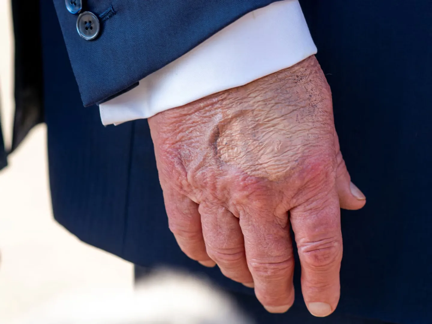 donald-trump-health-vein-disease-update