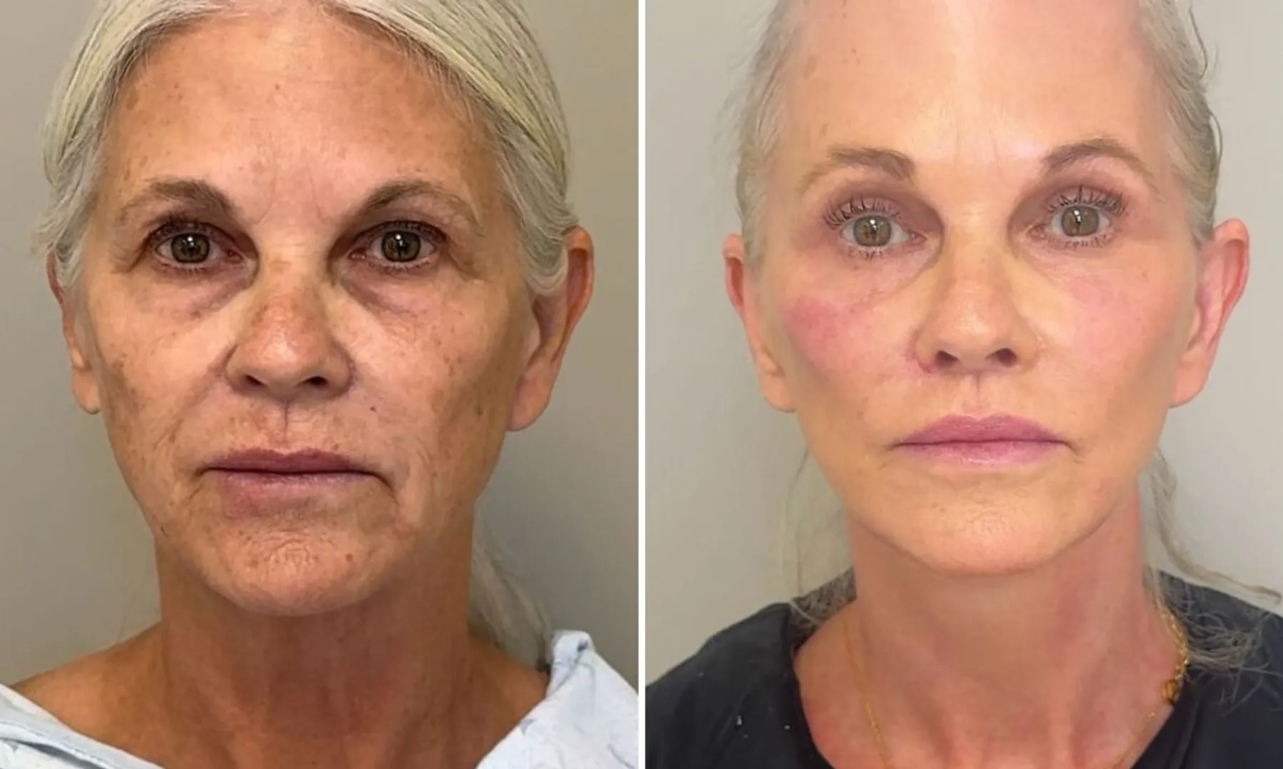 9 procedures, 6 hours, 1 incredible glow-up Meet the woman who reversed aging