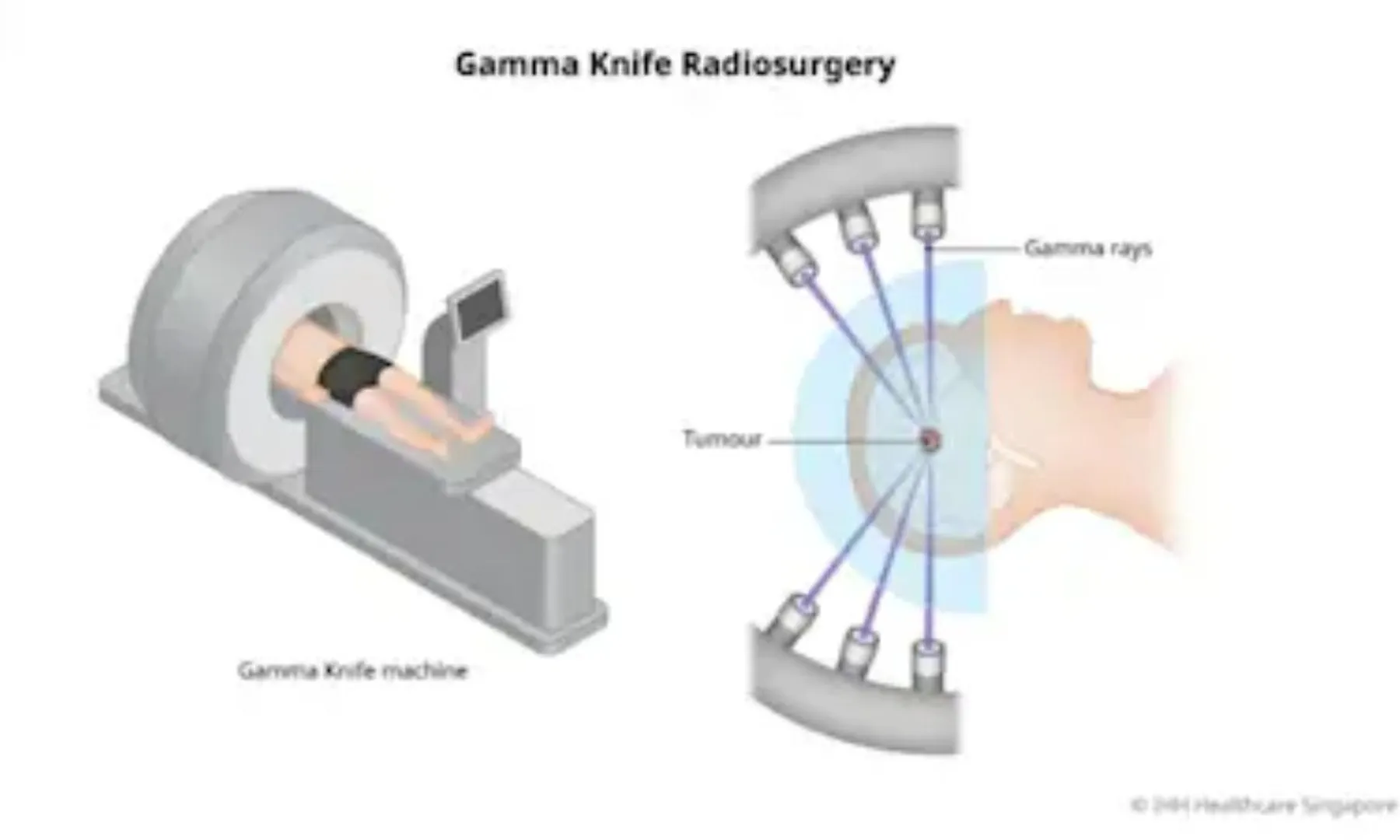  Tumours can now be treated without surgery: UP to get its first non-surgical brain treatment centre post image
