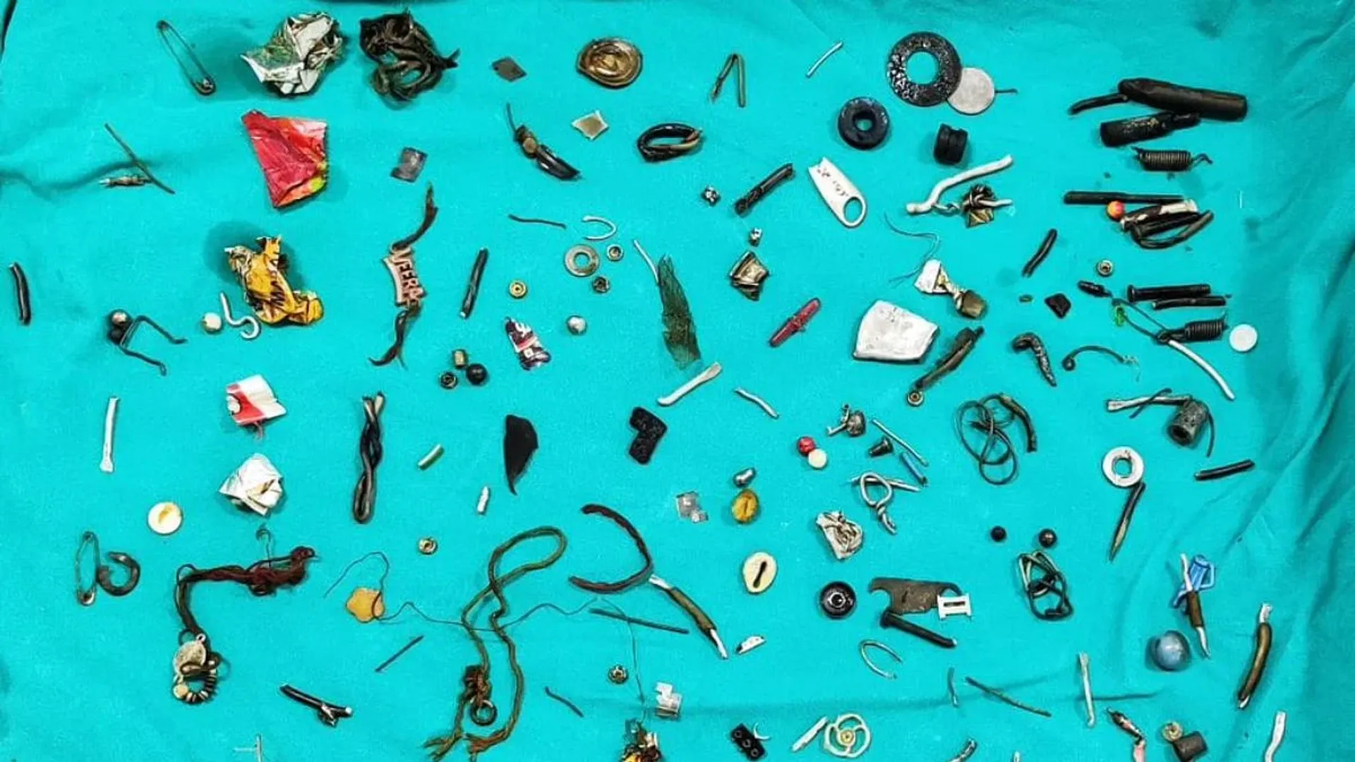 Earphones, screws, and lockets found inside man's stomach, life-saving surgery lasts for 3 hours