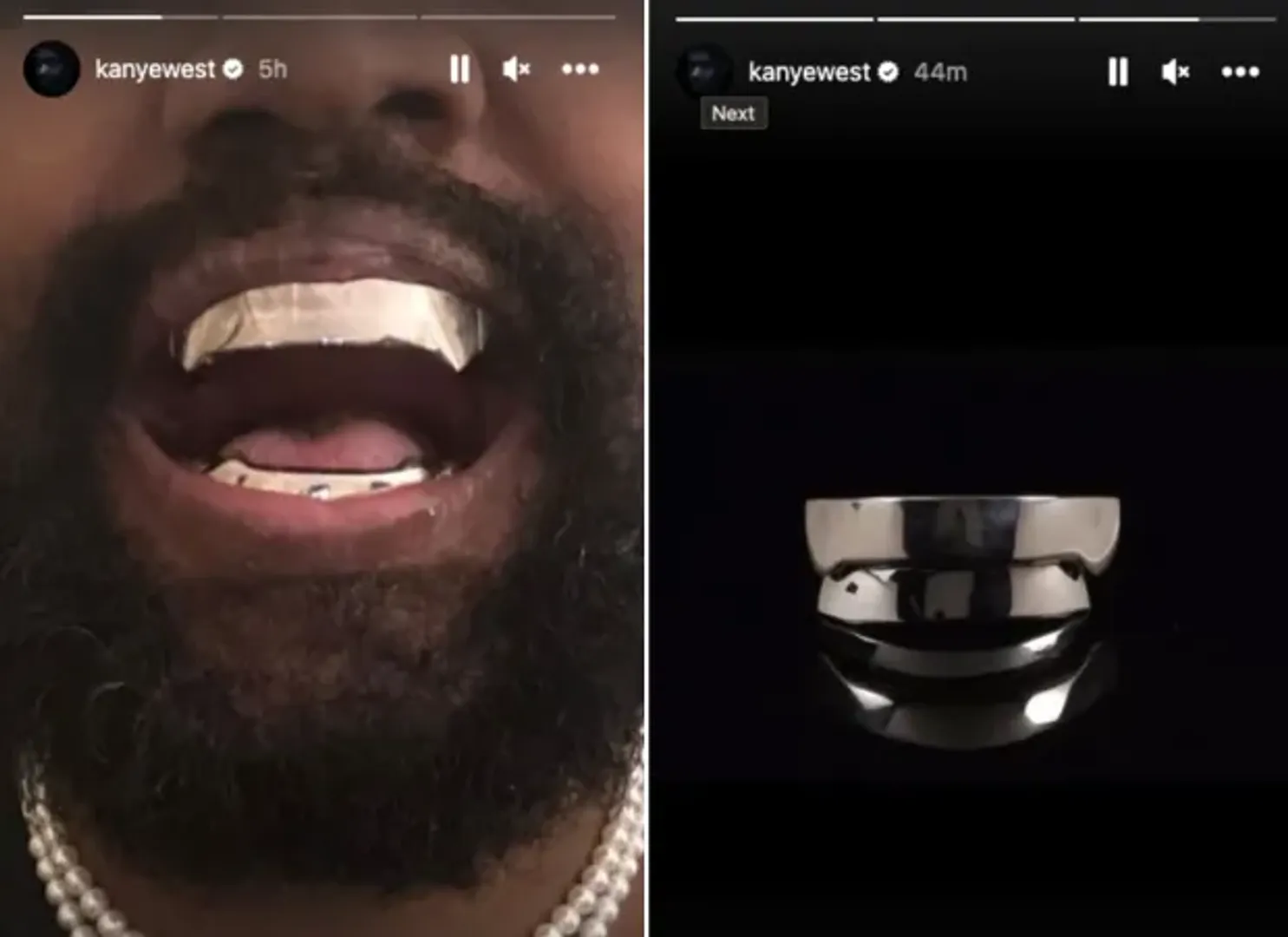 Kanye gets titanium teeth, daughter North gets diamond grills!