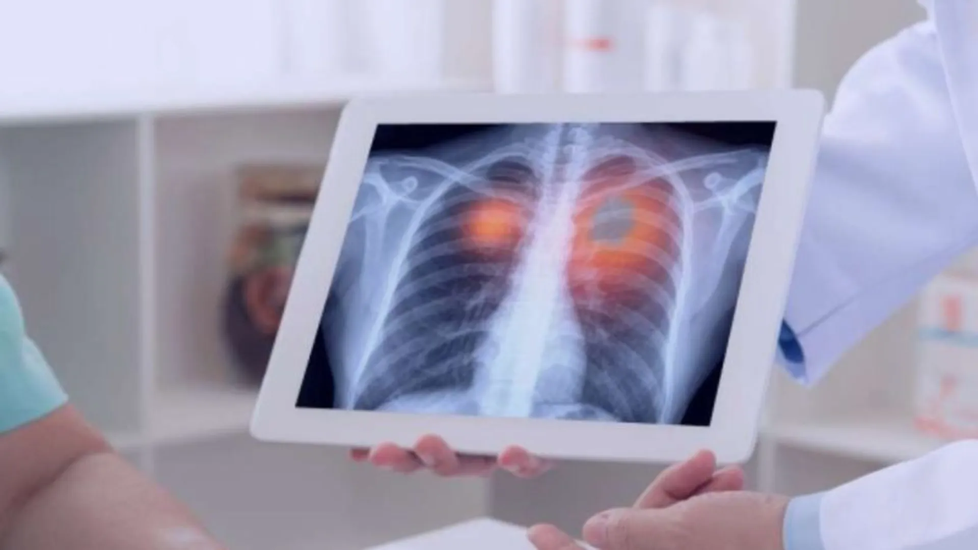 lung cancer patients