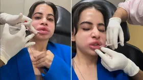 Urfi Javed-Lip Filler: লিপ ফিলারের পর চোখ-মুখ ফুলে ঢোল! কটাক্ষের মাঝে নতুন ছবি পোস্ট করে কী বার্তা উরফির?