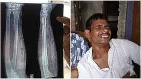 mysterious needles:যুবকের শরীরে গুচ্ছ-গুচ্ছ রহস্যজনক সুচ, 'কালাজাদু' আতঙ্ক পরিবারের! টিম পাঠাচ্ছে স্বাস্থ্য দফতর