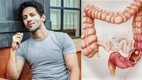 क्या है कोलन कैंसर और इसके लक्षण? जिससे हुई टीवी एक्टर Vibhu Raghave की मौत