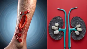 Uric Acid बढ़ने से हो सकती है किडनी स्टोन की दिक्कत,  ऐसे करें इसका इलाज