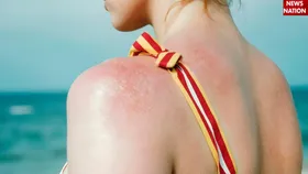गर्मी में घमौरियों से बचने के लिए अपनाए ये देसी नुस्खे, मिलेगी राहत