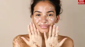 World Vitiligo Day 2025 पर जानिए क्यों होते हैं शरीर पर सफेद दाग और इसके लक्षण