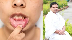 मुंह में छालों से हैं परेशान, तो अपनाएं आचार्य बालकृष्ण के ये उपाय