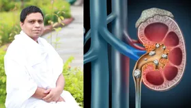 पथरी से छुटकारा पाने के लिए अपनाएं आचार्य बालकृष्ण के ये उपाय, मिलेगी राहत