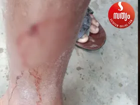 തെരുവുനായ ആക്രമണത്തിൽ ഭയന്ന് മുതുകുർശ്ശി; രണ്ടു ദിവസത്തിനിടെ പതിനൊന്നോളം ആളുകളെ ആക്രമിച്ചു