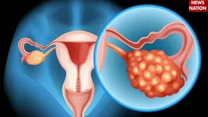 Ovarian Cancer