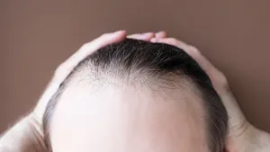 Bald Hair: బట్టతల పోవాలంటే ఈ ఆయిల్ రాయండి... ఇక రమ్మన్నా రాదు