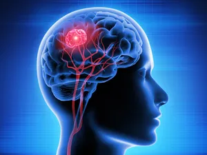 brain tumour  post image