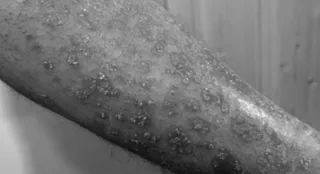 10-20 pc women experience psoriasis during pregnancy