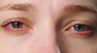 Just 1 hour of smartphone reels can trigger eye fatigue, finds study