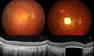 New retinal implant restores vision in patients with irreversible blindness