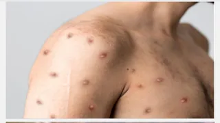 Second MPox case detected in India